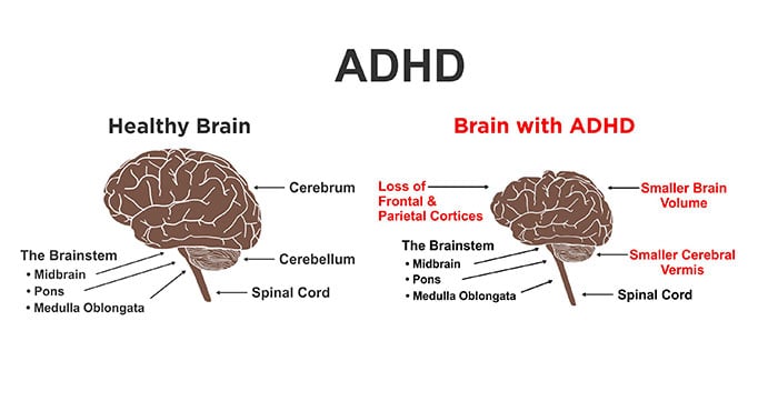 Healthy Brain vs ADHD brain